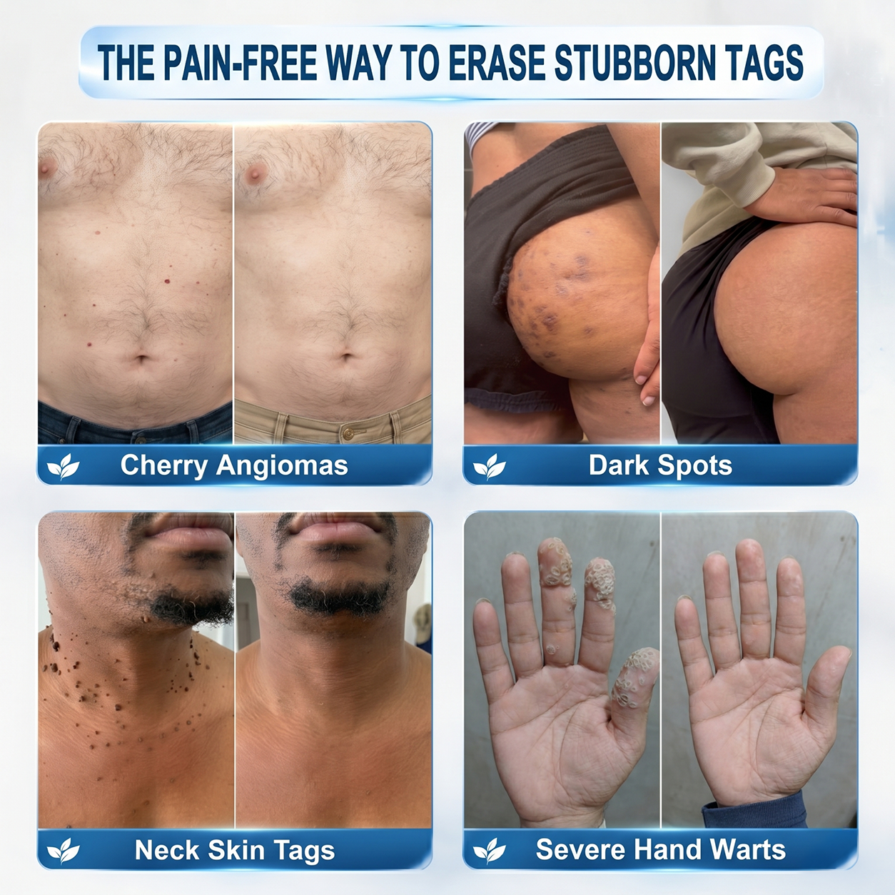 𝐎𝐟𝐟𝐢𝐜𝐢𝐚𝐥 𝐁𝐫𝐚𝐧𝐝 𝐒𝐭𝐨𝐫𝐞 |✅🎉Natravor® 7-𝐷𝑎𝑦 Skin Tag and Spot Removal Cream(Zero Pain, Zero 𝐒𝐜𝐚𝒓𝒔 )