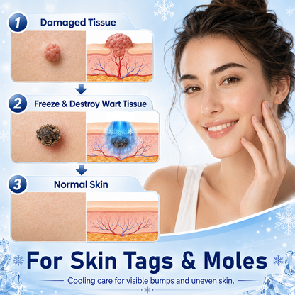 Zero Pain💎Natravor® Cryotherapy Wart Remover Spray（Botanical Extracts · Advanced Cryotherapy Technology · Targeted Care for Warts & Skin Bumps）