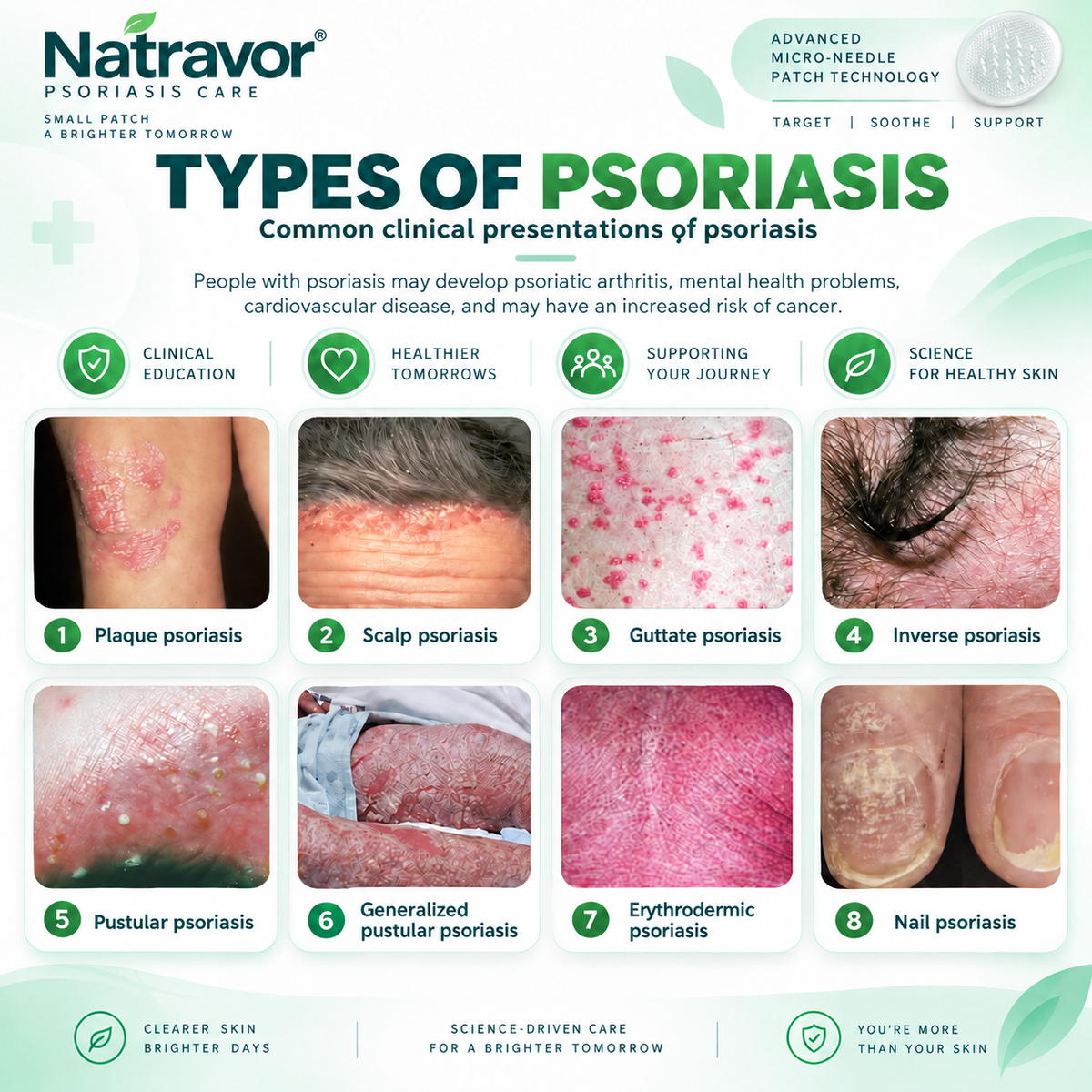 🔥 Only 10 left! Get 30% OFF your second purchase! Natravor® helps reduce visible scaling, redness, dryness & itching while supporting psoriasis-prone skin. Limited stock — don’t miss out! 💚