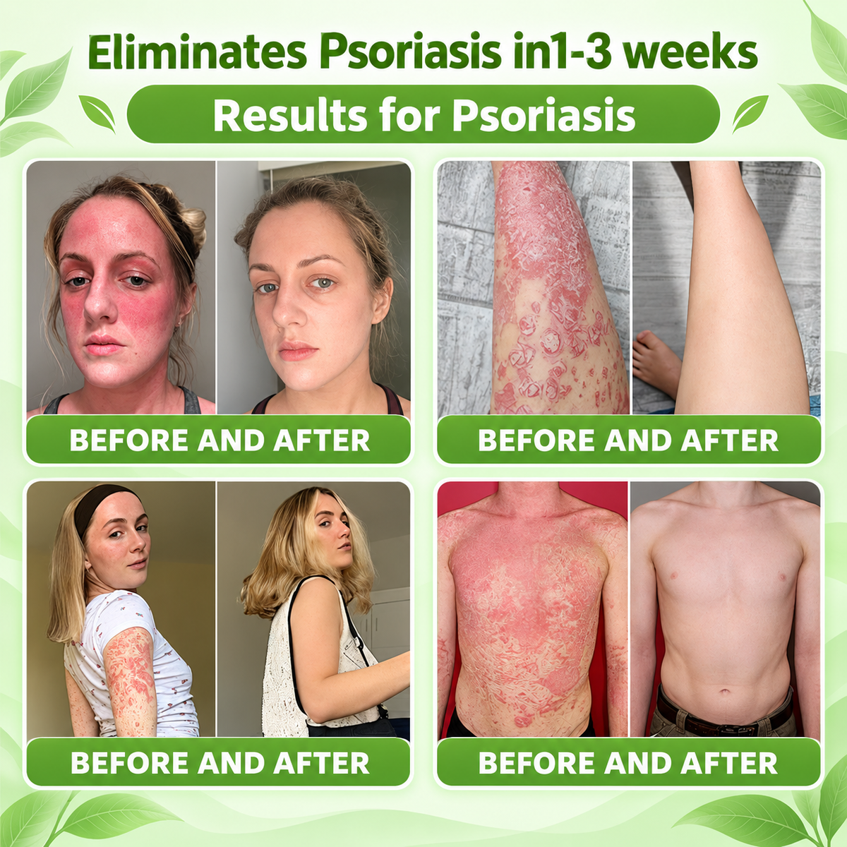 🔥 Only 10 left! Get 30% OFF your second purchase! Natravor® helps reduce visible scaling, redness, dryness & itching while supporting psoriasis-prone skin. Limited stock — don’t miss out! 💚