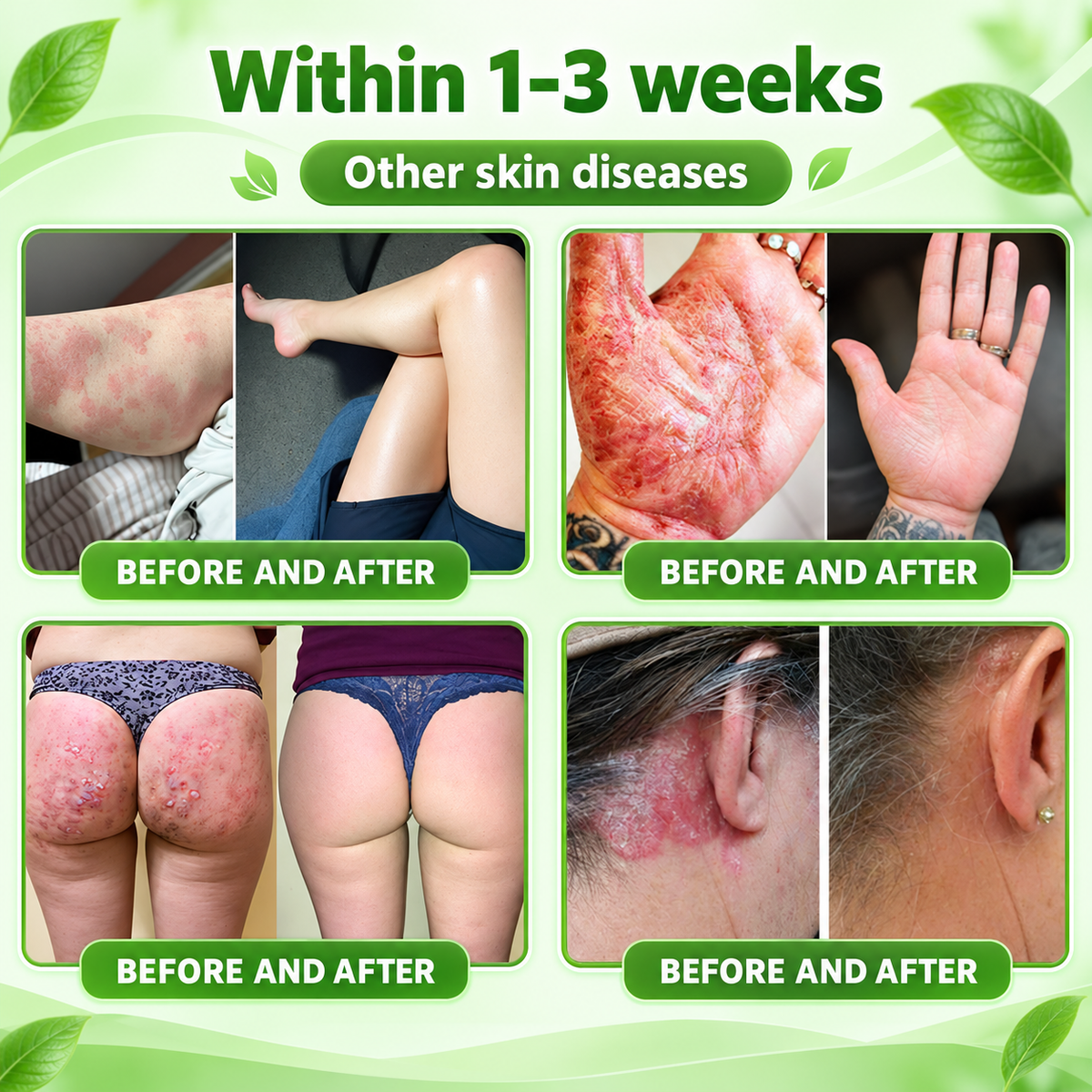 🔥 Only 10 left! Get 30% OFF your second purchase! Natravor® helps reduce visible scaling, redness, dryness & itching while supporting psoriasis-prone skin. Limited stock — don’t miss out! 💚