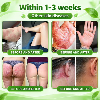 🔥 Only 10 left! Get 30% OFF your second purchase! Natravor® helps reduce visible scaling, redness, dryness & itching while supporting psoriasis-prone skin. Limited stock — don’t miss out! 💚