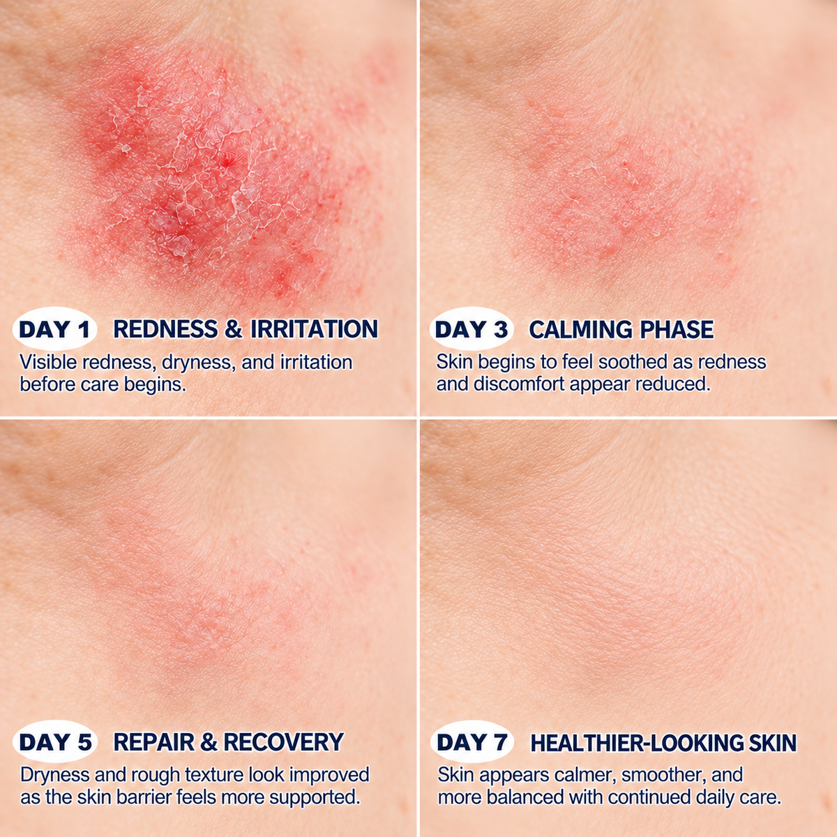 Natravor® 7-Day Skin Renewal Repair Cream — Soothe Itching, Then Restore (Gentle, Pain-Free Skin Repair Formula) 💎