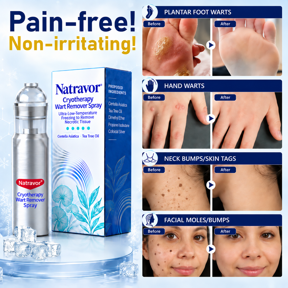 Zero Pain💎Natravor® Cryotherapy Wart Remover Spray（Botanical Extracts · Advanced Cryotherapy Technology · Targeted Care for Warts & Skin Bumps）