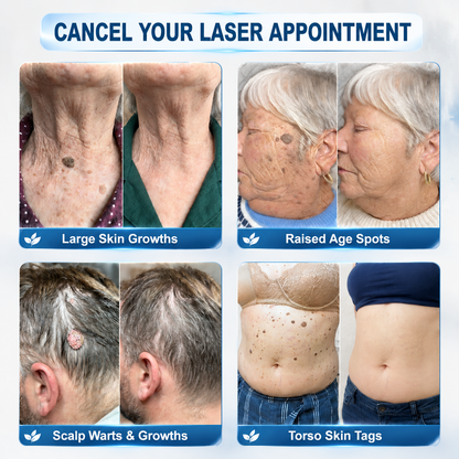 𝐎𝐟𝐟𝐢𝐜𝐢𝐚𝐥 𝐁𝐫𝐚𝐧𝐝 𝐒𝐭𝐨𝐫𝐞 |✅🎉Natravor® 7-𝐷𝑎𝑦 Skin Tag and Spot Removal Cream(Zero Pain, Zero 𝐒𝐜𝐚𝒓𝒔 )